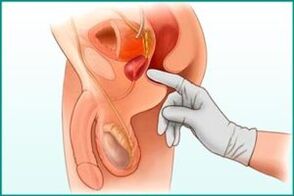 Palparea prostatei