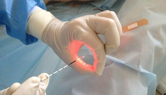 tratament cu laser pentru prostatita